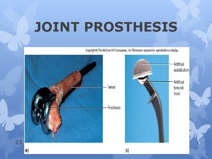 JOINT PROSTHESIS 25 