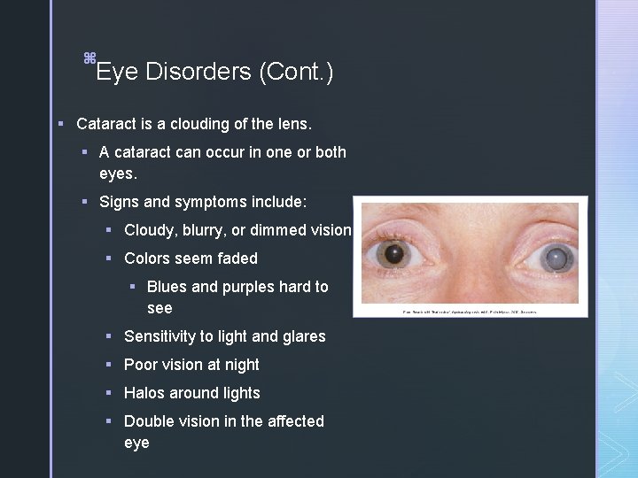 16 z z Eye Disorders (Cont. ) § Cataract is a clouding of the