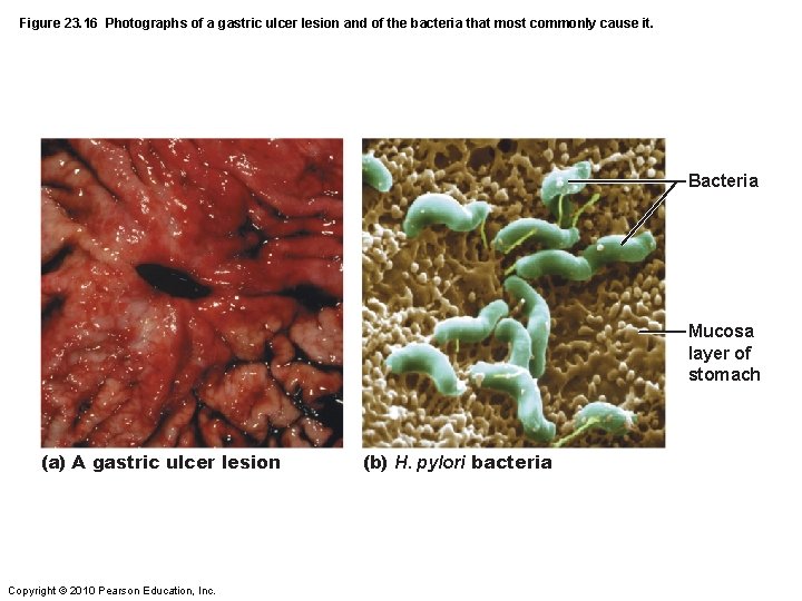 Figure 23. 16 Photographs of a gastric ulcer lesion and of the bacteria that