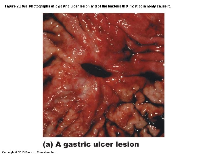 Figure 23. 16 a Photographs of a gastric ulcer lesion and of the bacteria