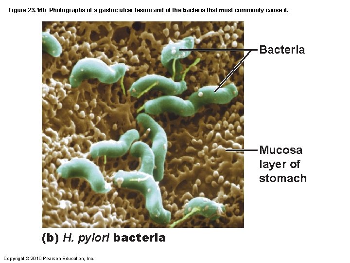 Figure 23. 16 b Photographs of a gastric ulcer lesion and of the bacteria