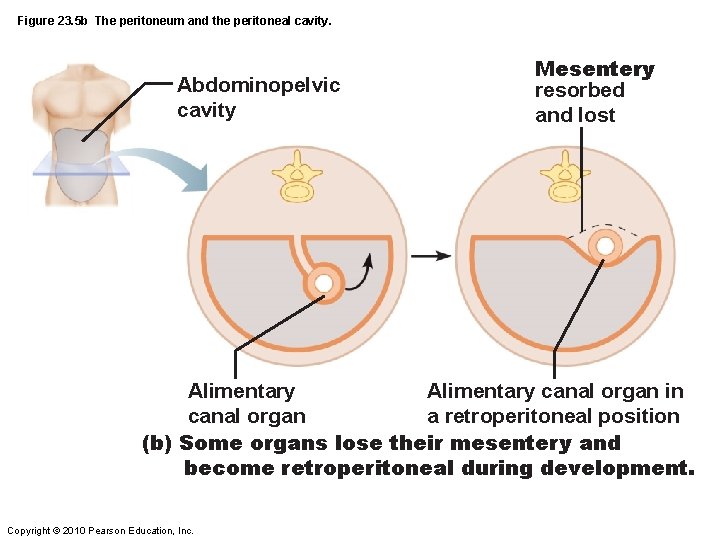 Figure 23. 5 b The peritoneum and the peritoneal cavity. Abdominopelvic cavity Mesentery resorbed