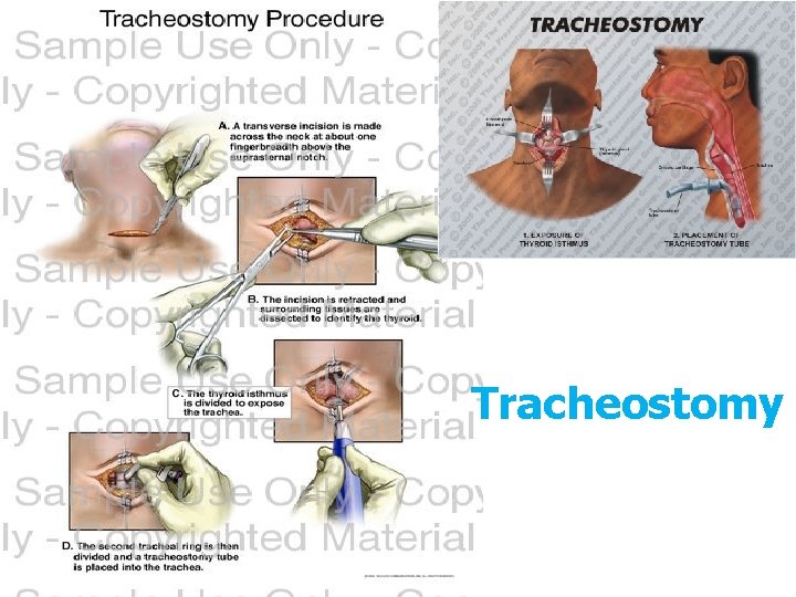 Tracheostomy 