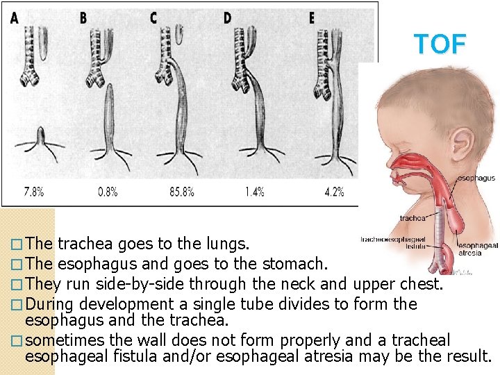 TOF � The trachea goes to the lungs. � The esophagus and goes to