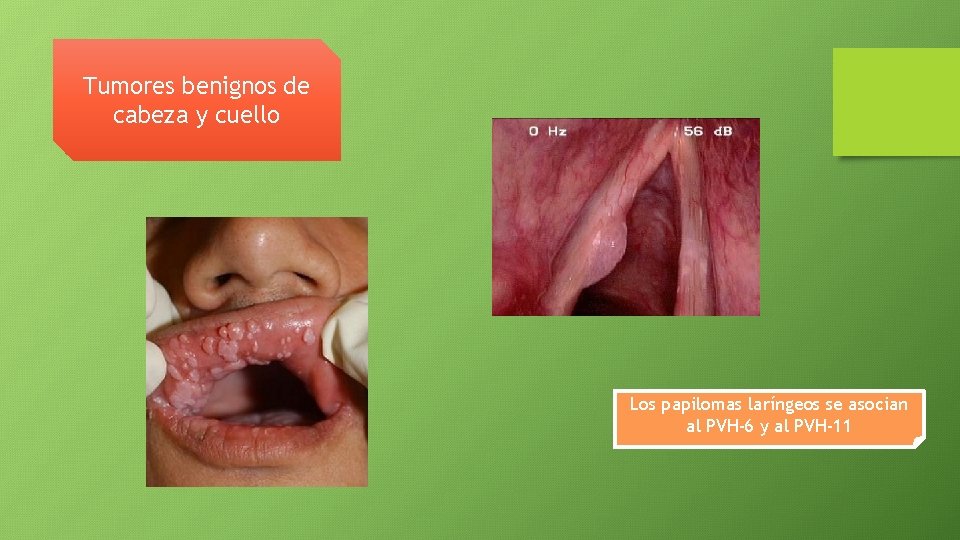 Tumores benignos de cabeza y cuello Los papilomas laríngeos se asocian al PVH-6 y