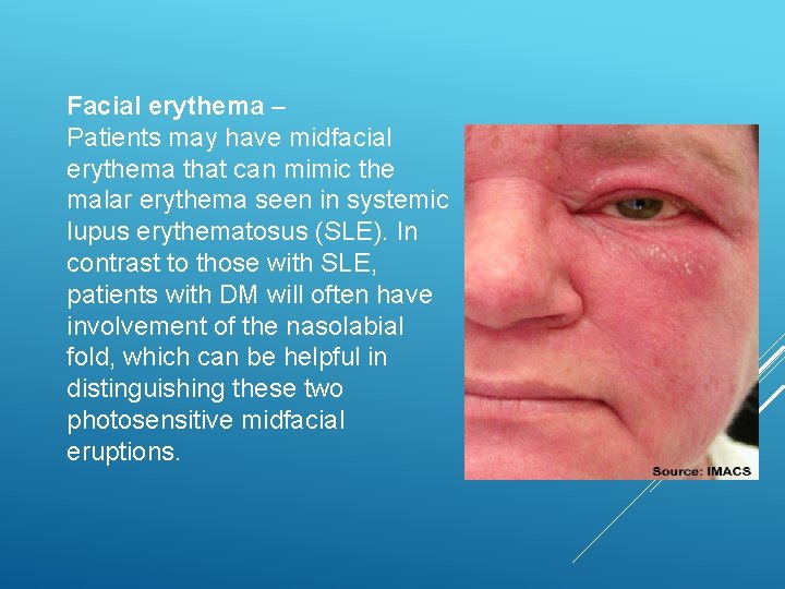 Facial erythema – Patients may have midfacial erythema that can mimic the malar erythema
