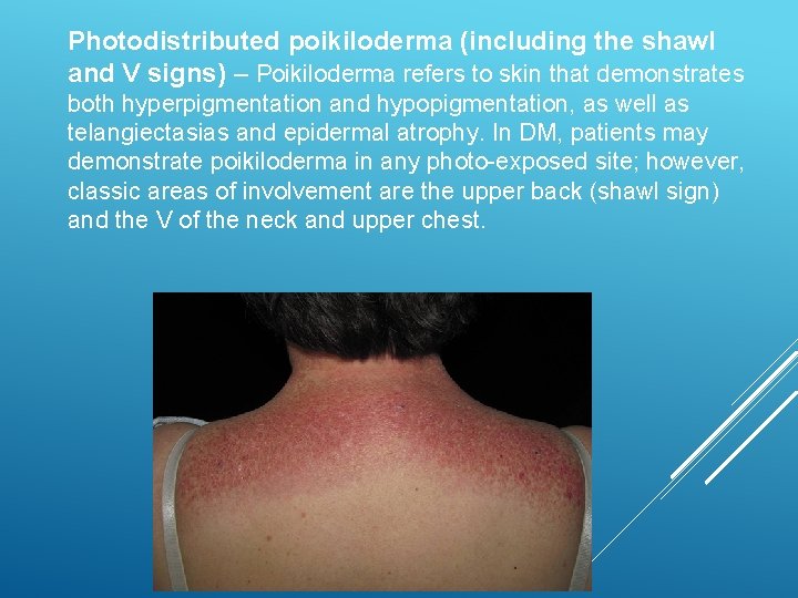 Photodistributed poikiloderma (including the shawl and V signs) – Poikiloderma refers to skin that