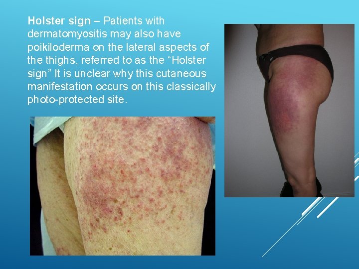Holster sign – Patients with dermatomyositis may also have poikiloderma on the lateral aspects