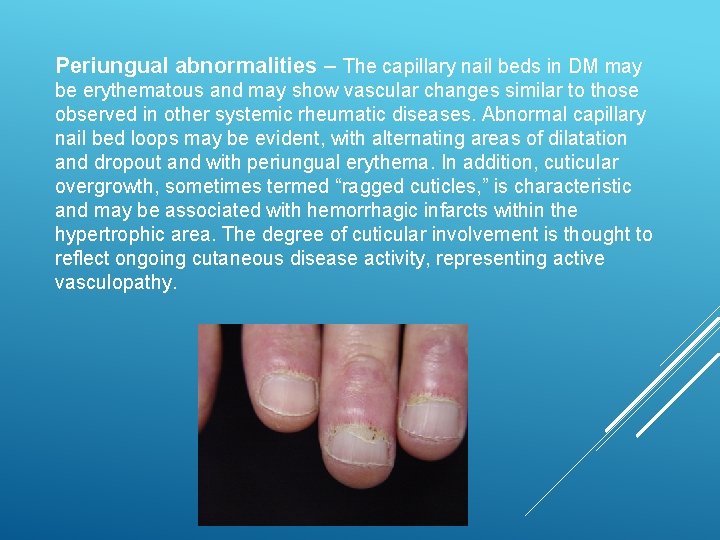 Periungual abnormalities – The capillary nail beds in DM may be erythematous and may