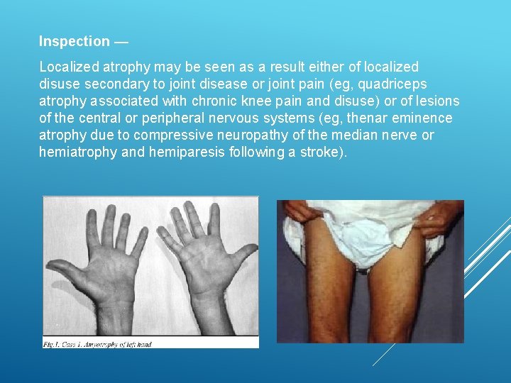 Inspection — Localized atrophy may be seen as a result either of localized disuse