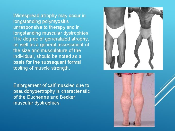 Widespread atrophy may occur in longstanding polymyositis unresponsive to therapy and in longstanding muscular