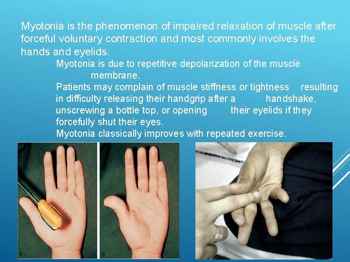 Myotonia is the phenomenon of impaired relaxation of muscle after forceful voluntary contraction and