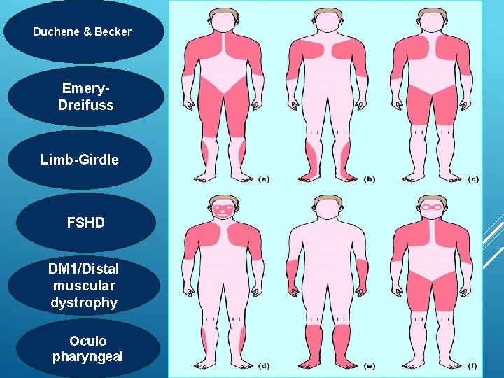 Duchene & Becker Emery. Dreifuss Limb-Girdle FSHD DM 1/Distal muscular dystrophy Oculo pharyngeal 