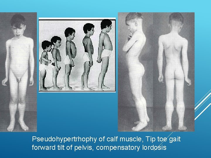 Pseudohypertrhophy of calf muscle, Tip toe gait forward tilt of pelvis, compensatory lordosis 