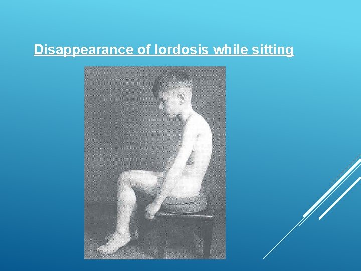 Disappearance of lordosis while sitting 