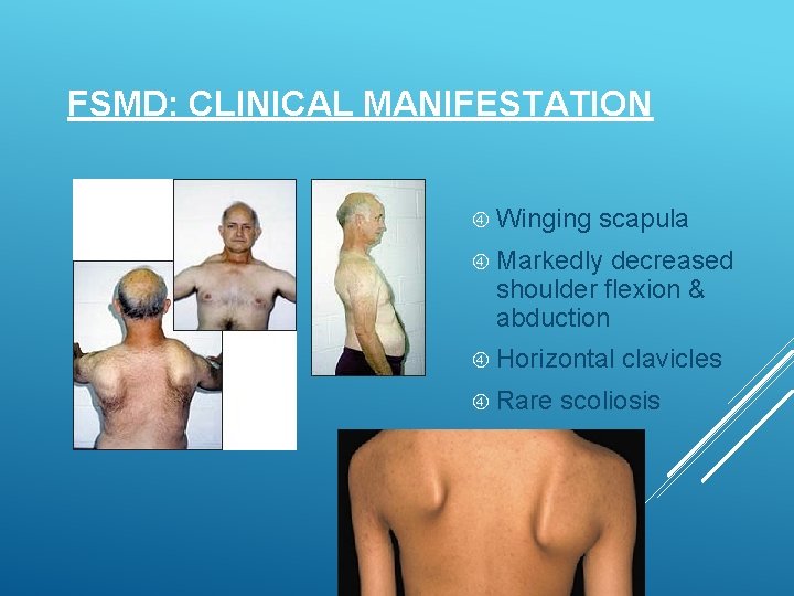 FSMD: CLINICAL MANIFESTATION Winging scapula Markedly decreased shoulder flexion & abduction Horizontal Rare clavicles