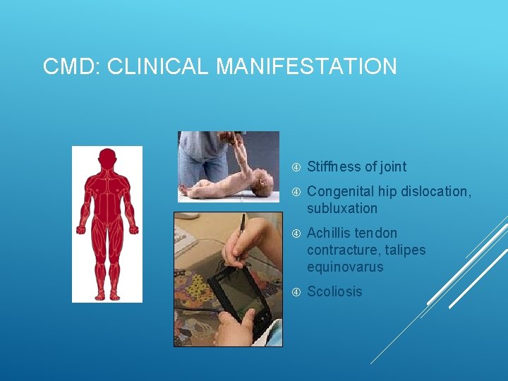 CMD: CLINICAL MANIFESTATION Stiffness of joint Congenital hip dislocation, subluxation Achillis tendon contracture, talipes