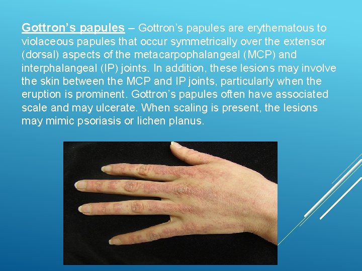 Gottron’s papules – Gottron’s papules are erythematous to violaceous papules that occur symmetrically over
