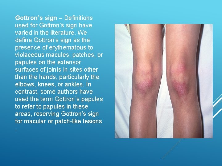 Gottron’s sign – Definitions used for Gottron’s sign have varied in the literature. We