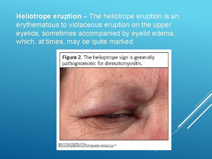 Heliotrope eruption – The heliotrope eruption is an erythematous to violaceous eruption on the