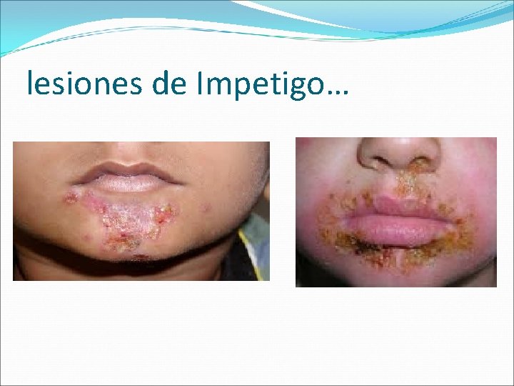 lesiones de Impetigo… 