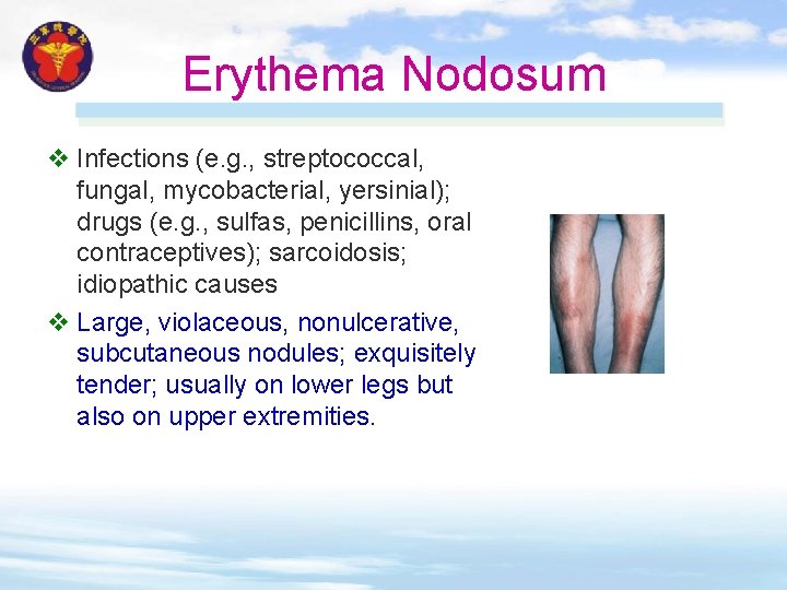 Erythema Nodosum v Infections (e. g. , streptococcal, fungal, mycobacterial, yersinial); drugs (e. g. Erythema Nodosum v Infections (e. g. , streptococcal, fungal, mycobacterial, yersinial); drugs (e. g.
