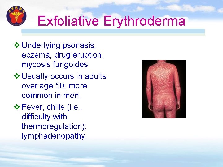 Exfoliative Erythroderma v Underlying psoriasis, eczema, drug eruption, mycosis fungoides v Usually occurs in Exfoliative Erythroderma v Underlying psoriasis, eczema, drug eruption, mycosis fungoides v Usually occurs in