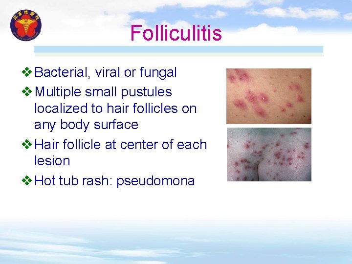 Folliculitis v Bacterial, viral or fungal v Multiple small pustules localized to hair follicles Folliculitis v Bacterial, viral or fungal v Multiple small pustules localized to hair follicles