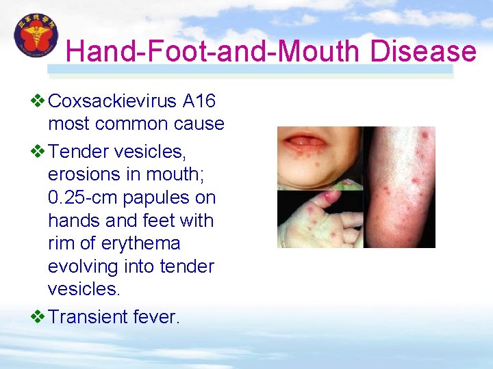 Hand-Foot-and-Mouth Disease v Coxsackievirus A 16 most common cause v Tender vesicles, erosions in Hand-Foot-and-Mouth Disease v Coxsackievirus A 16 most common cause v Tender vesicles, erosions in