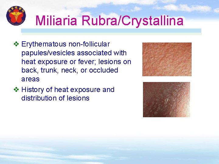 Miliaria Rubra/Crystallina v Erythematous non-follicular papules/vesicles associated with heat exposure or fever; lesions on Miliaria Rubra/Crystallina v Erythematous non-follicular papules/vesicles associated with heat exposure or fever; lesions on