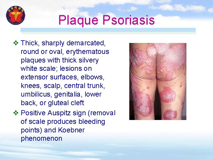 Plaque Psoriasis v Thick, sharply demarcated, round or oval, erythematous plaques with thick silvery Plaque Psoriasis v Thick, sharply demarcated, round or oval, erythematous plaques with thick silvery