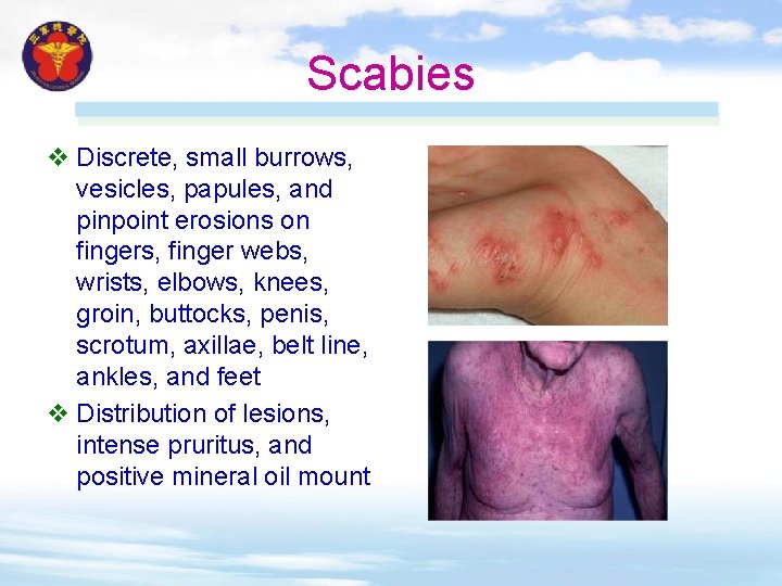 Scabies v Discrete, small burrows, vesicles, papules, and pinpoint erosions on fingers, finger webs, Scabies v Discrete, small burrows, vesicles, papules, and pinpoint erosions on fingers, finger webs,