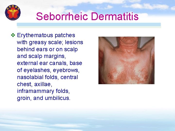 Seborrheic Dermatitis v Erythematous patches with greasy scale; lesions behind ears or on scalp Seborrheic Dermatitis v Erythematous patches with greasy scale; lesions behind ears or on scalp
