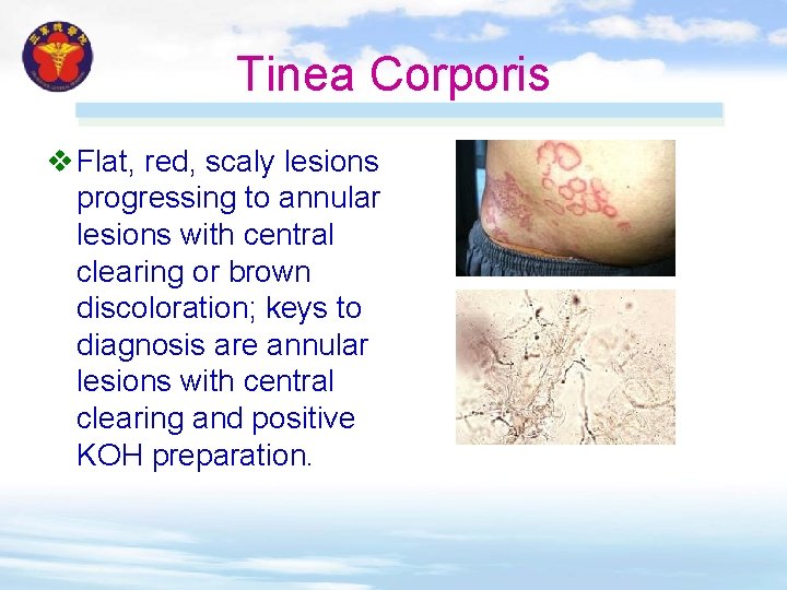 Tinea Corporis v Flat, red, scaly lesions progressing to annular lesions with central clearing Tinea Corporis v Flat, red, scaly lesions progressing to annular lesions with central clearing