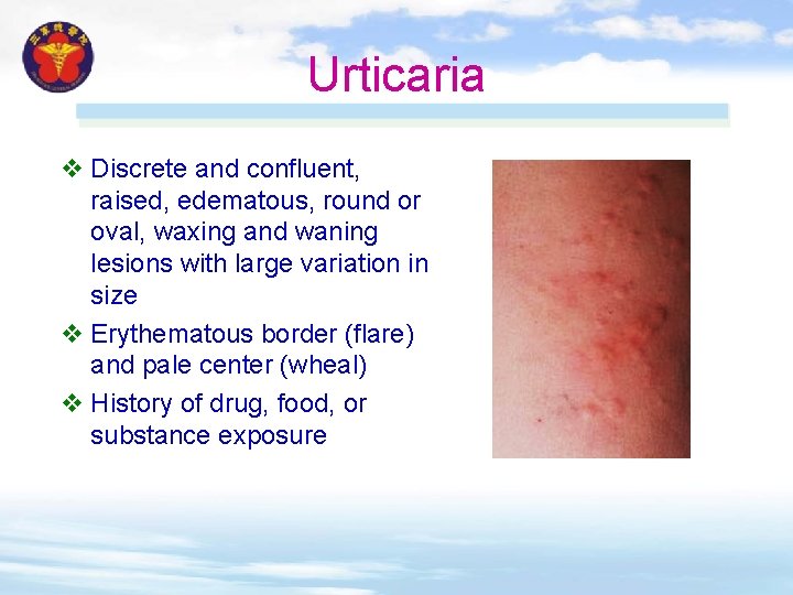 Urticaria v Discrete and confluent, raised, edematous, round or oval, waxing and waning lesions Urticaria v Discrete and confluent, raised, edematous, round or oval, waxing and waning lesions