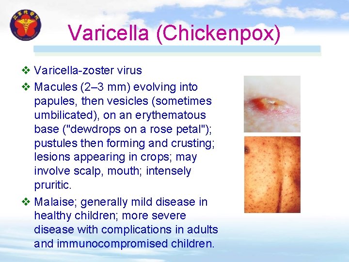 Varicella (Chickenpox) v Varicella-zoster virus v Macules (2– 3 mm) evolving into papules, then Varicella (Chickenpox) v Varicella-zoster virus v Macules (2– 3 mm) evolving into papules, then