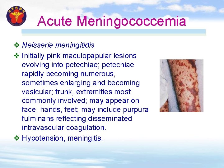 Acute Meningococcemia v Neisseria meningitidis v Initially pink maculopapular lesions evolving into petechiae; petechiae Acute Meningococcemia v Neisseria meningitidis v Initially pink maculopapular lesions evolving into petechiae; petechiae