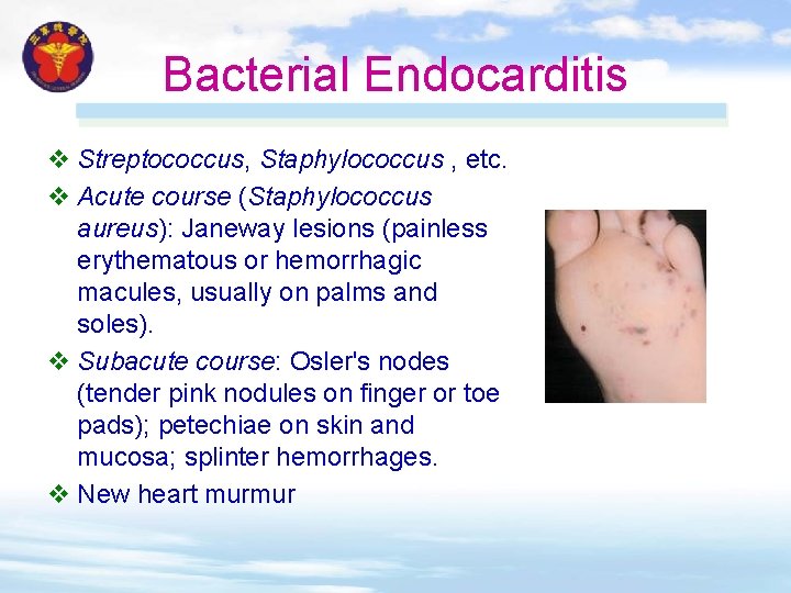 Bacterial Endocarditis v Streptococcus, Staphylococcus , etc. v Acute course (Staphylococcus aureus): Janeway lesions Bacterial Endocarditis v Streptococcus, Staphylococcus , etc. v Acute course (Staphylococcus aureus): Janeway lesions