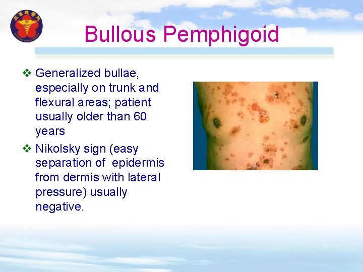 Bullous Pemphigoid v Generalized bullae, especially on trunk and flexural areas; patient usually older Bullous Pemphigoid v Generalized bullae, especially on trunk and flexural areas; patient usually older