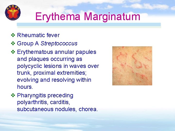 Erythema Marginatum v Rheumatic fever v Group A Streptococcus v Erythematous annular papules and Erythema Marginatum v Rheumatic fever v Group A Streptococcus v Erythematous annular papules and