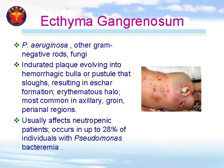 Ecthyma Gangrenosum v P. aeruginosa , other gramnegative rods, fungi v Indurated plaque evolving Ecthyma Gangrenosum v P. aeruginosa , other gramnegative rods, fungi v Indurated plaque evolving