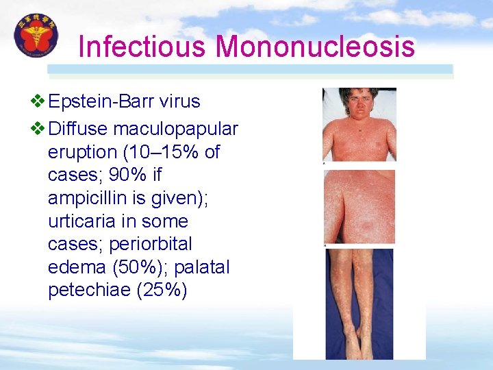 Infectious Mononucleosis v Epstein-Barr virus v Diffuse maculopapular eruption (10– 15% of cases; 90% Infectious Mononucleosis v Epstein-Barr virus v Diffuse maculopapular eruption (10– 15% of cases; 90%