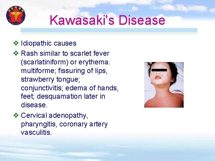 Kawasaki's Disease v Idiopathic causes v Rash similar to scarlet fever (scarlatiniform) or erythema. Kawasaki's Disease v Idiopathic causes v Rash similar to scarlet fever (scarlatiniform) or erythema.