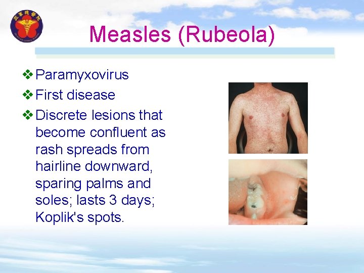 Measles (Rubeola) v Paramyxovirus v First disease v Discrete lesions that become confluent as Measles (Rubeola) v Paramyxovirus v First disease v Discrete lesions that become confluent as