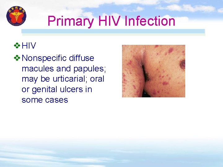 Primary HIV Infection v HIV v Nonspecific diffuse macules and papules; may be urticarial; Primary HIV Infection v HIV v Nonspecific diffuse macules and papules; may be urticarial;