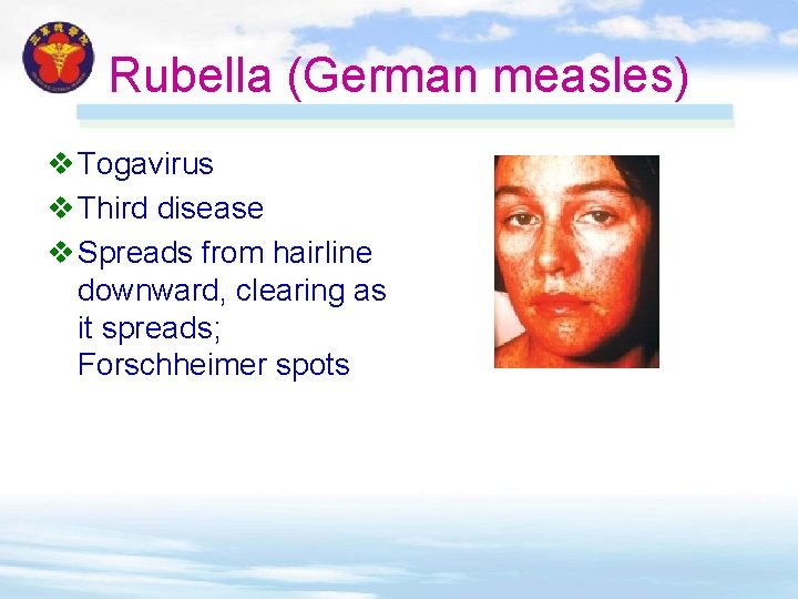 Rubella (German measles) v Togavirus v Third disease v Spreads from hairline downward, clearing Rubella (German measles) v Togavirus v Third disease v Spreads from hairline downward, clearing