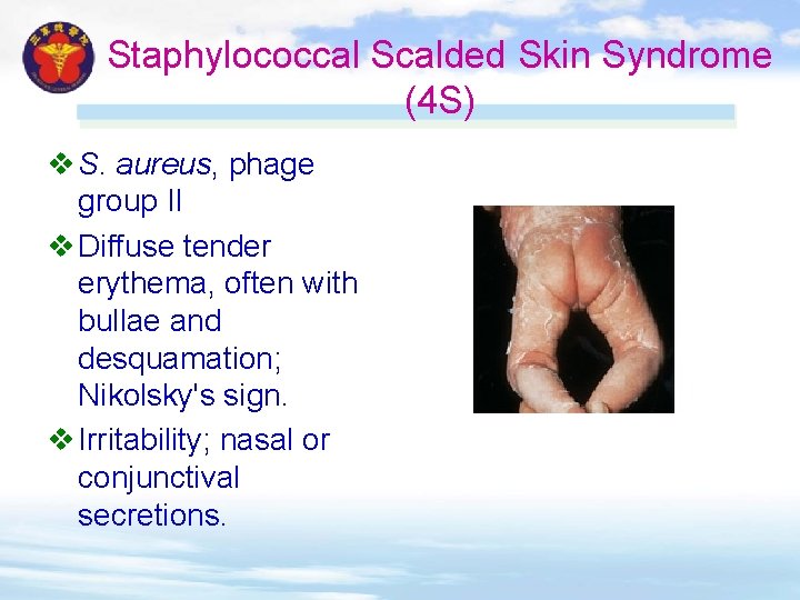 Staphylococcal Scalded Skin Syndrome (4 S) v S. aureus, phage group II v Diffuse Staphylococcal Scalded Skin Syndrome (4 S) v S. aureus, phage group II v Diffuse