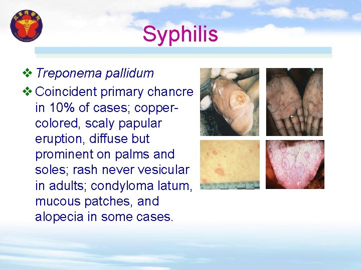 Syphilis v Treponema pallidum v Coincident primary chancre in 10% of cases; coppercolored, scaly Syphilis v Treponema pallidum v Coincident primary chancre in 10% of cases; coppercolored, scaly
