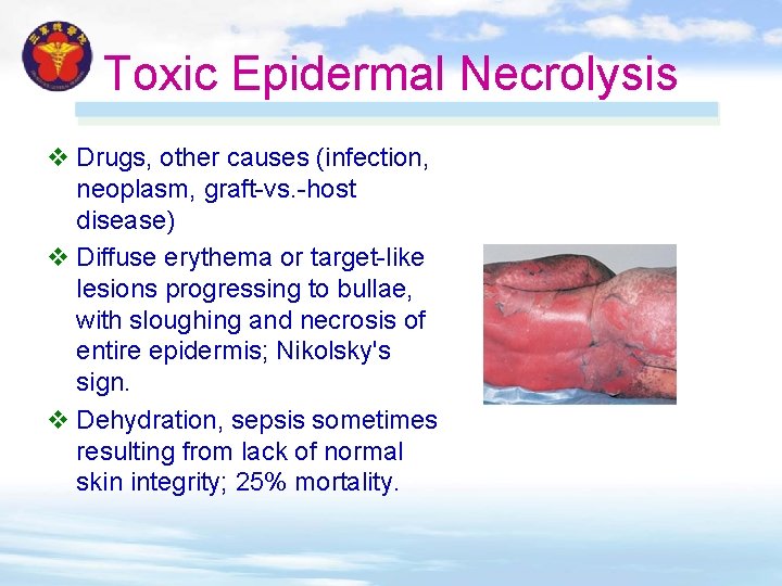 Toxic Epidermal Necrolysis v Drugs, other causes (infection, neoplasm, graft-vs. -host disease) v Diffuse Toxic Epidermal Necrolysis v Drugs, other causes (infection, neoplasm, graft-vs. -host disease) v Diffuse
