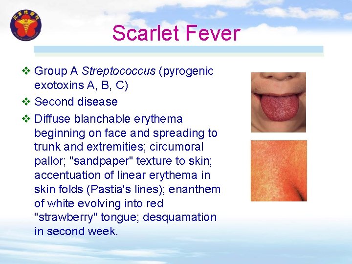 Scarlet Fever v Group A Streptococcus (pyrogenic exotoxins A, B, C) v Second disease Scarlet Fever v Group A Streptococcus (pyrogenic exotoxins A, B, C) v Second disease